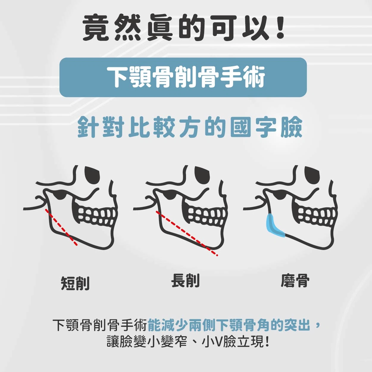 你也想擁有《我獨自升級》成振宇那樣的俐落尖下巴嗎?現實中竟然真的可以! 你也想擁有《我獨自升級》成振宇那樣的俐落尖下巴嗎?現實中竟然真的可以!