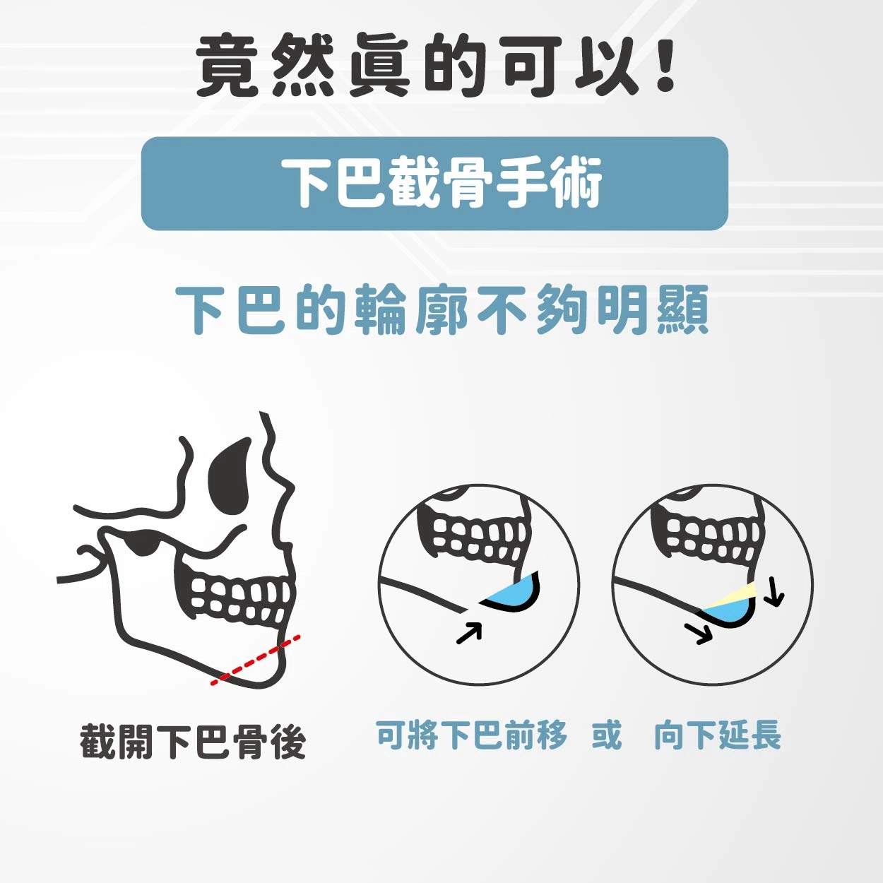 你也想擁有《我獨自升級》成振宇那樣的俐落尖下巴嗎?現實中竟然真的可以! 你也想擁有《我獨自升級》成振宇那樣的俐落尖下巴嗎?現實中竟然真的可以!