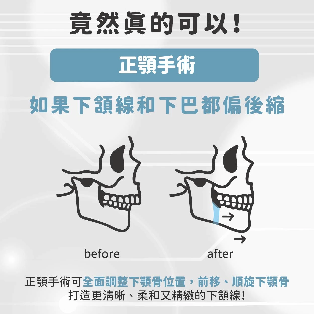 你也想擁有《我獨自升級》成振宇那樣的俐落尖下巴嗎?現實中竟然真的可以! 你也想擁有《我獨自升級》成振宇那樣的俐落尖下巴嗎?現實中竟然真的可以!