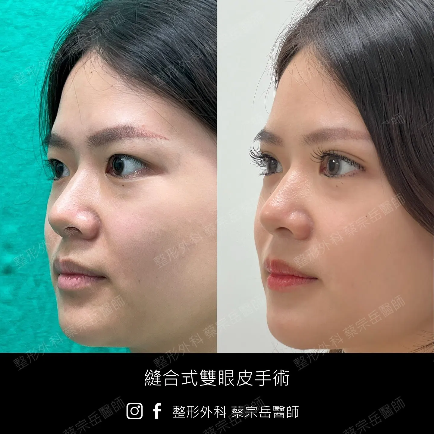 縫合式雙眼皮手術