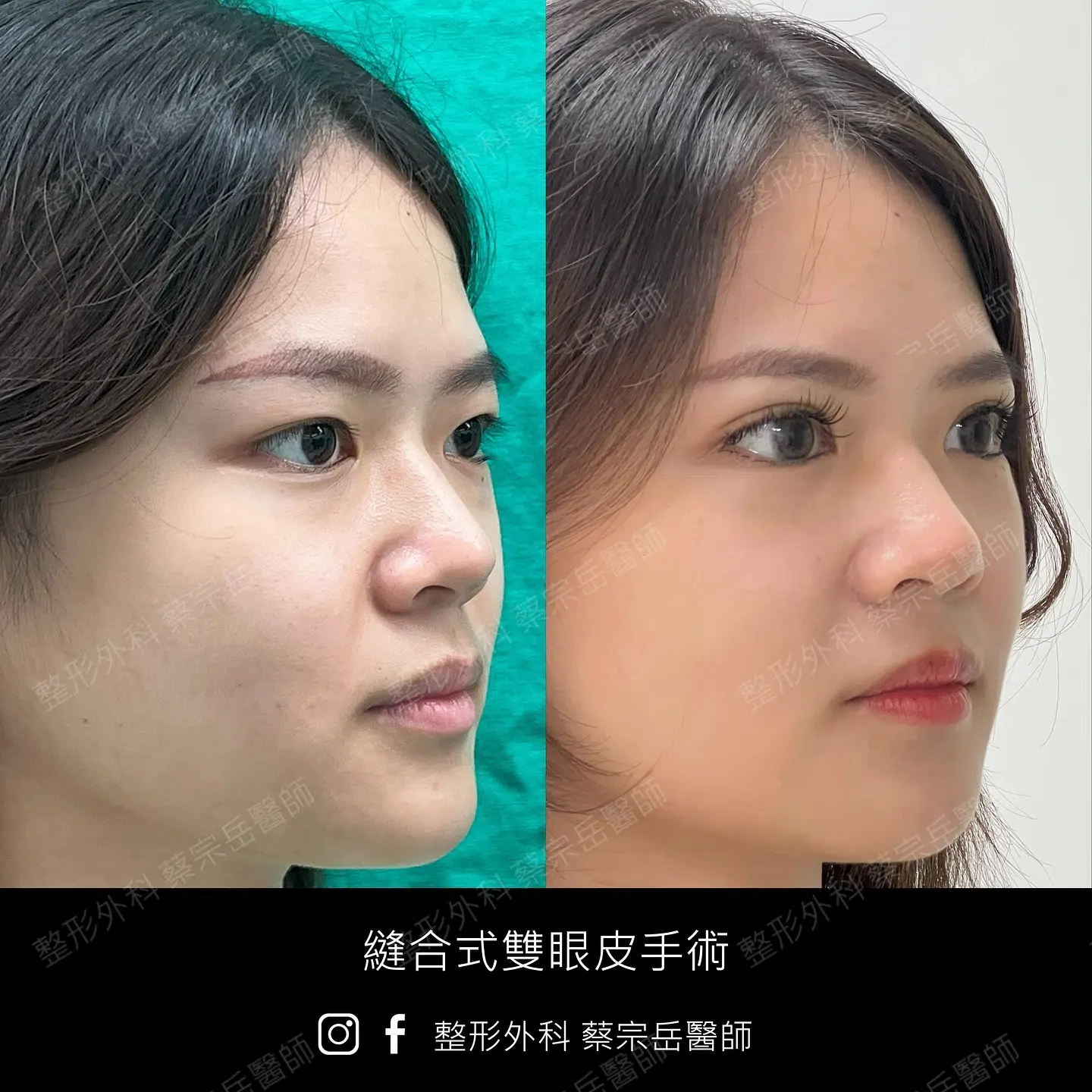 縫合式雙眼皮手術