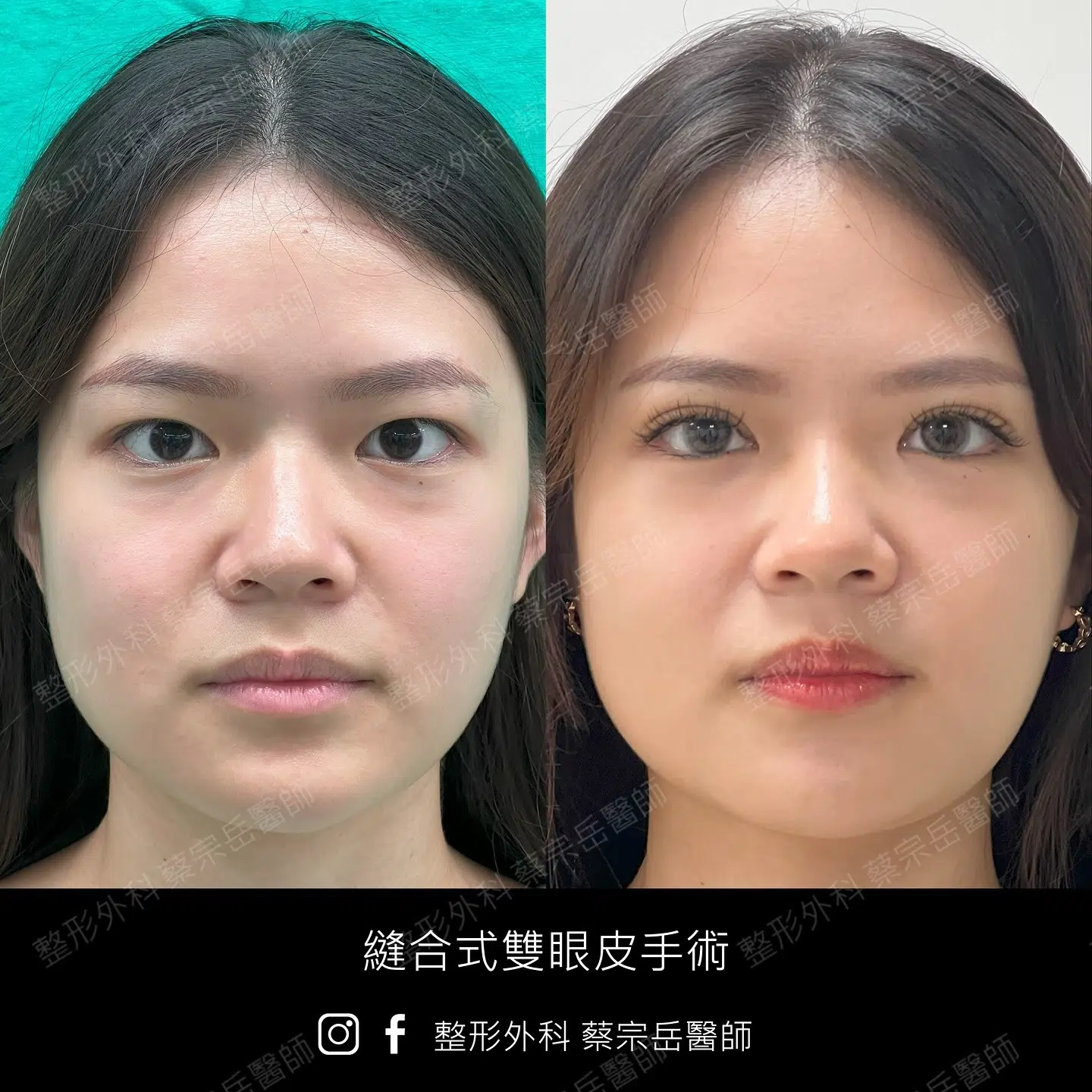 縫合式雙眼皮手術