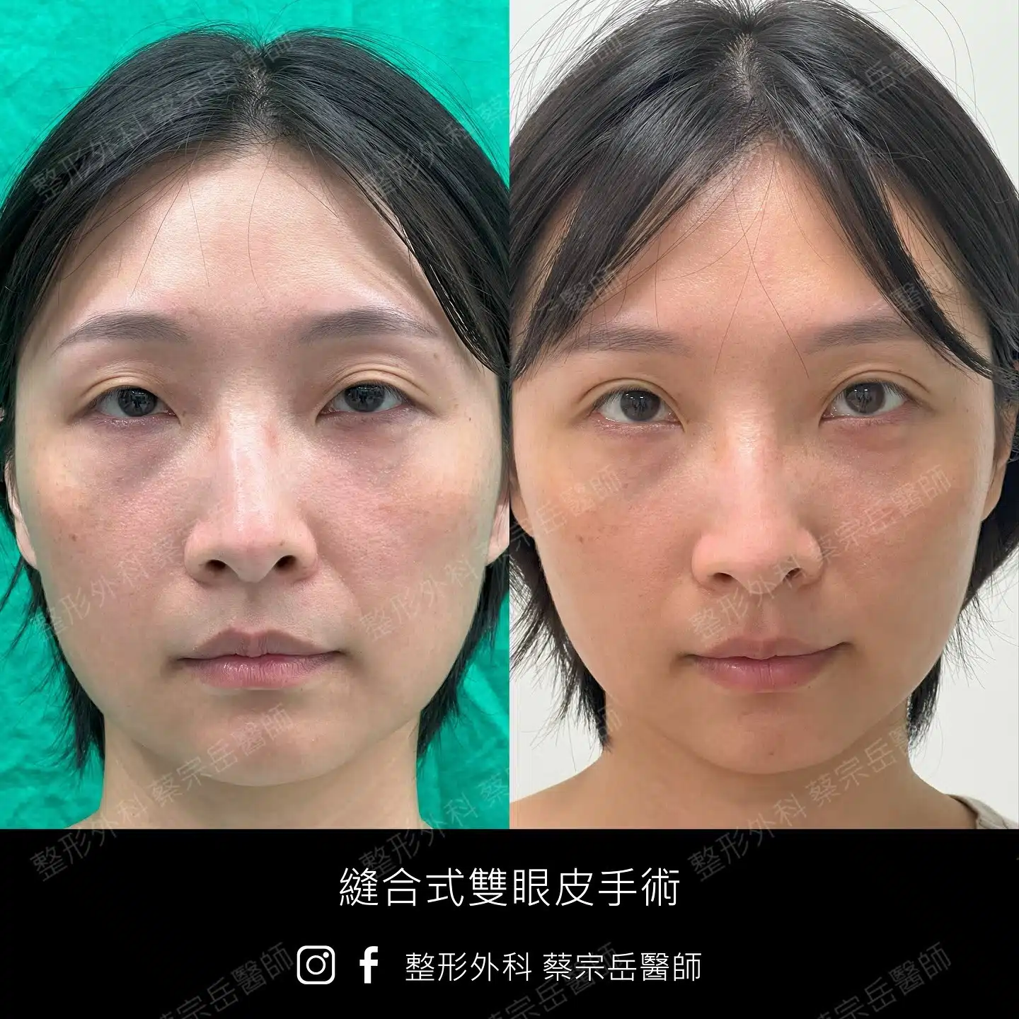 縫合式雙眼皮手術