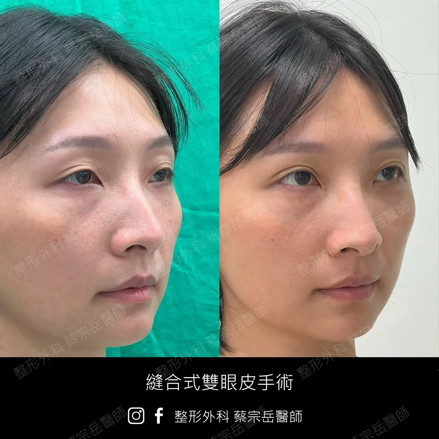 縫合式雙眼皮手術