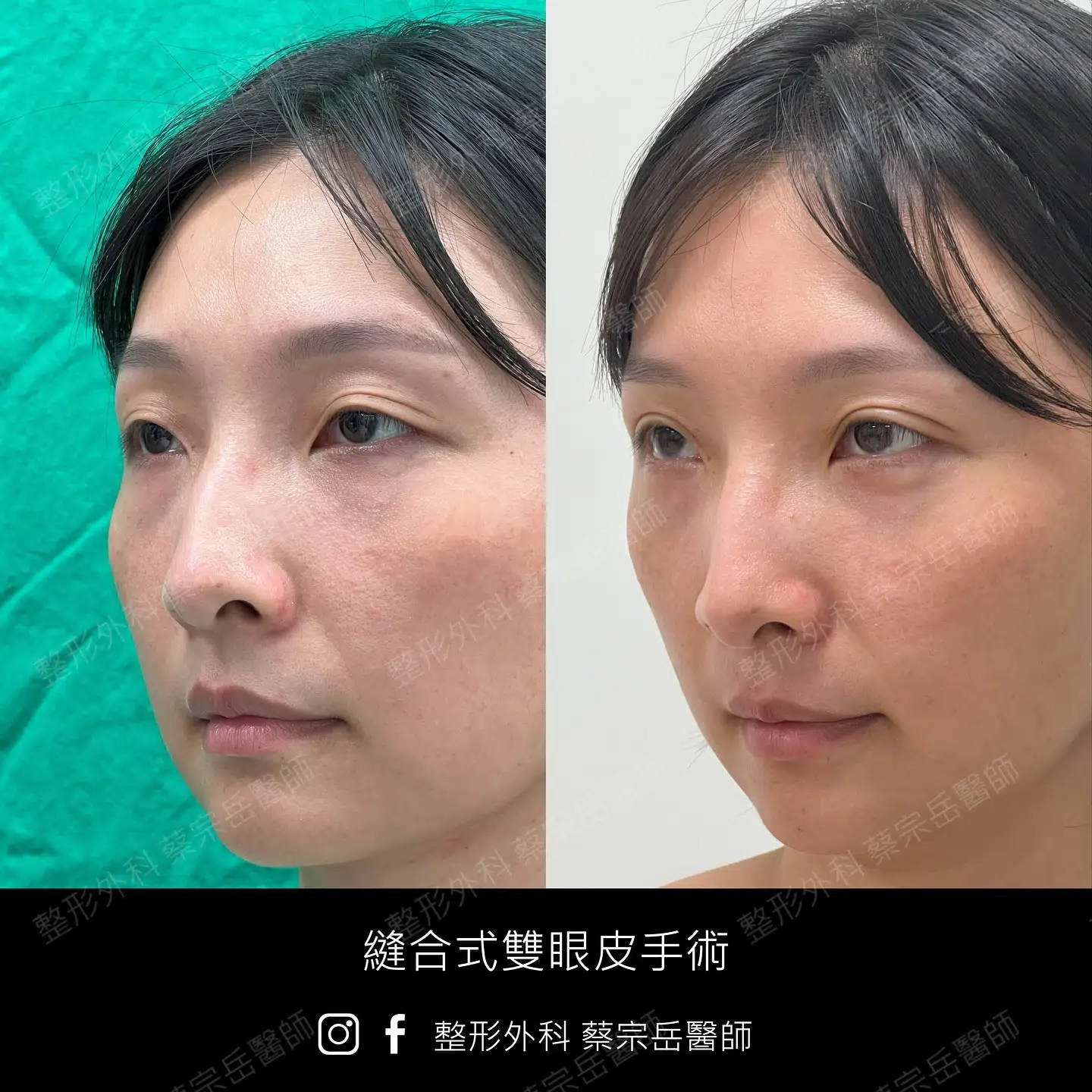 縫合式雙眼皮手術