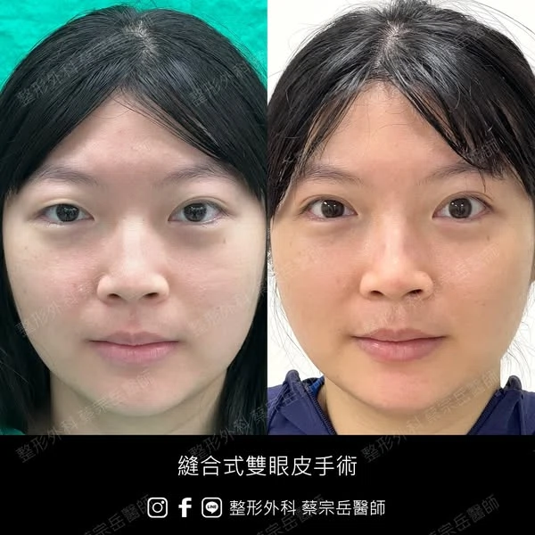 縫合式雙眼皮手術