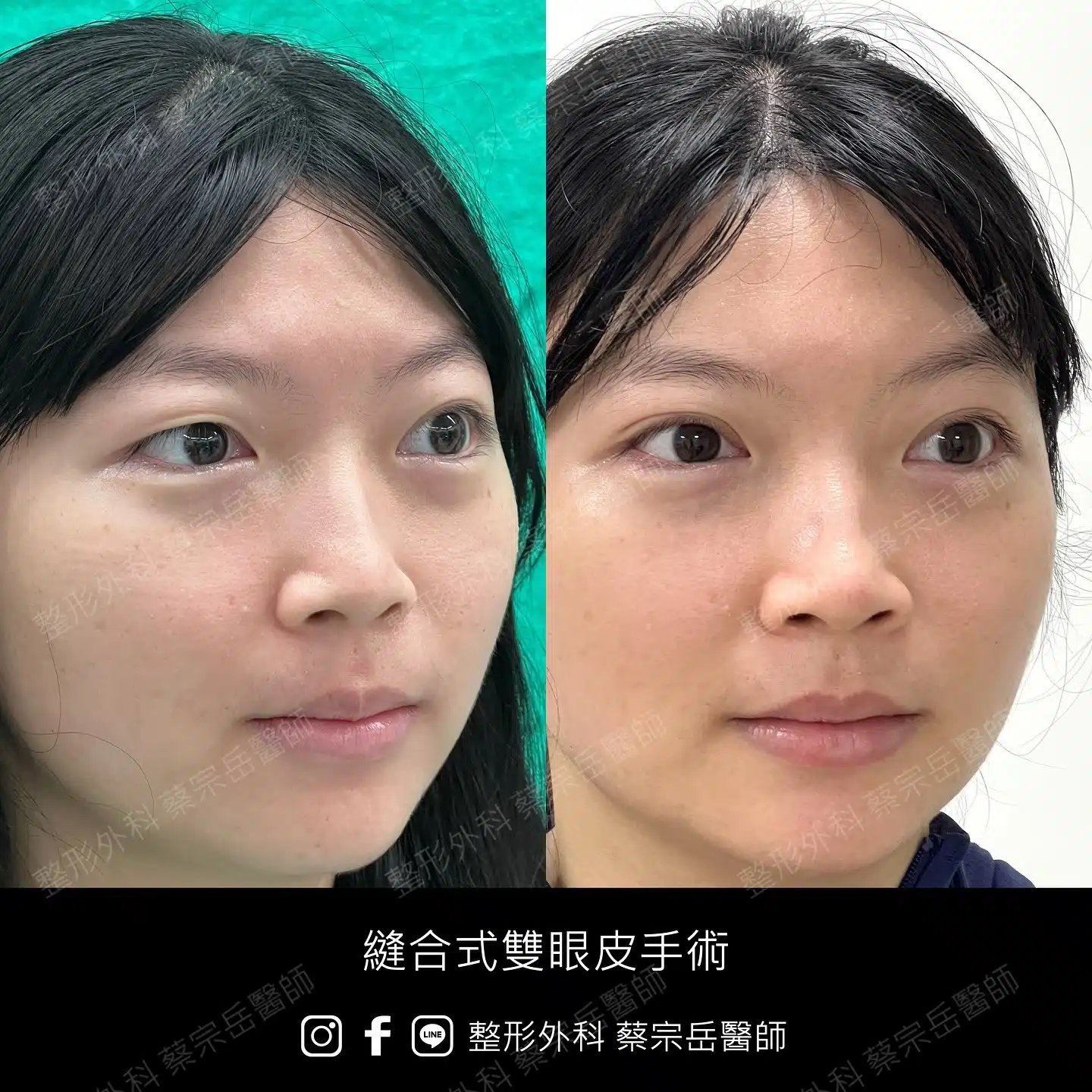 縫合式雙眼皮手術