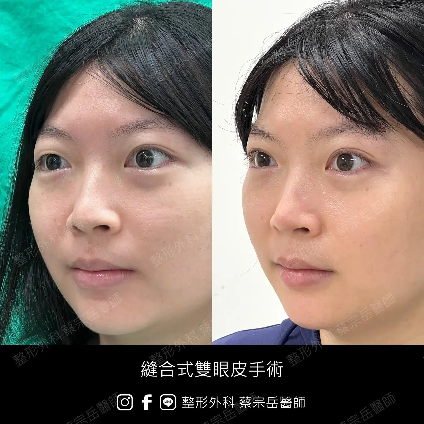 縫合式雙眼皮手術