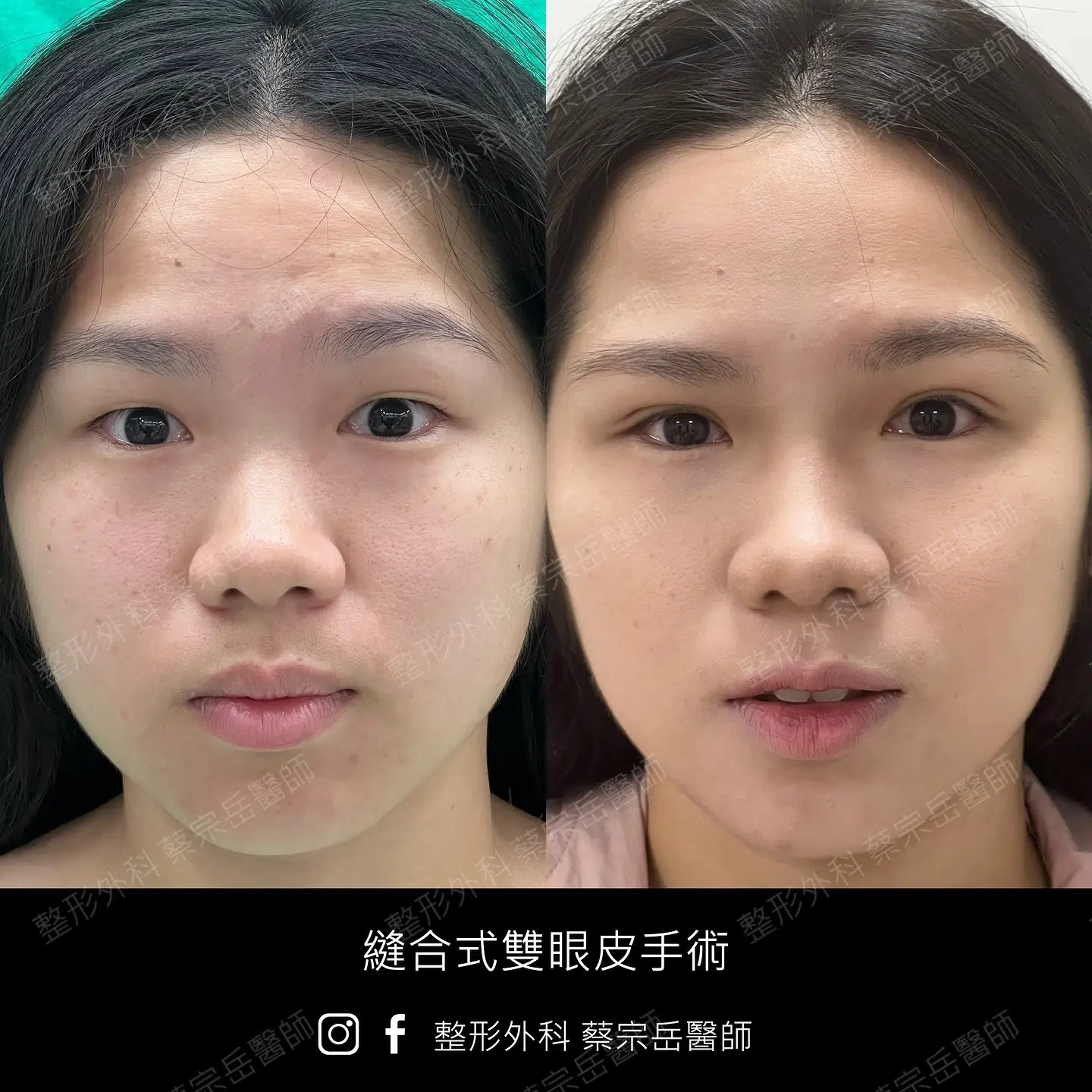 縫合式雙眼皮手術