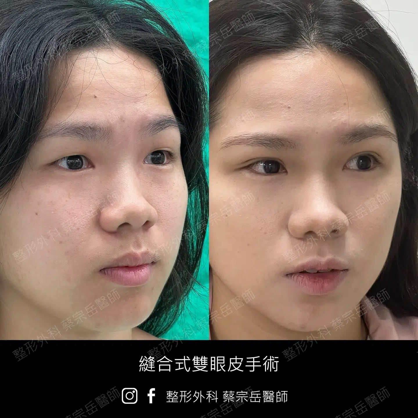 縫合式雙眼皮手術