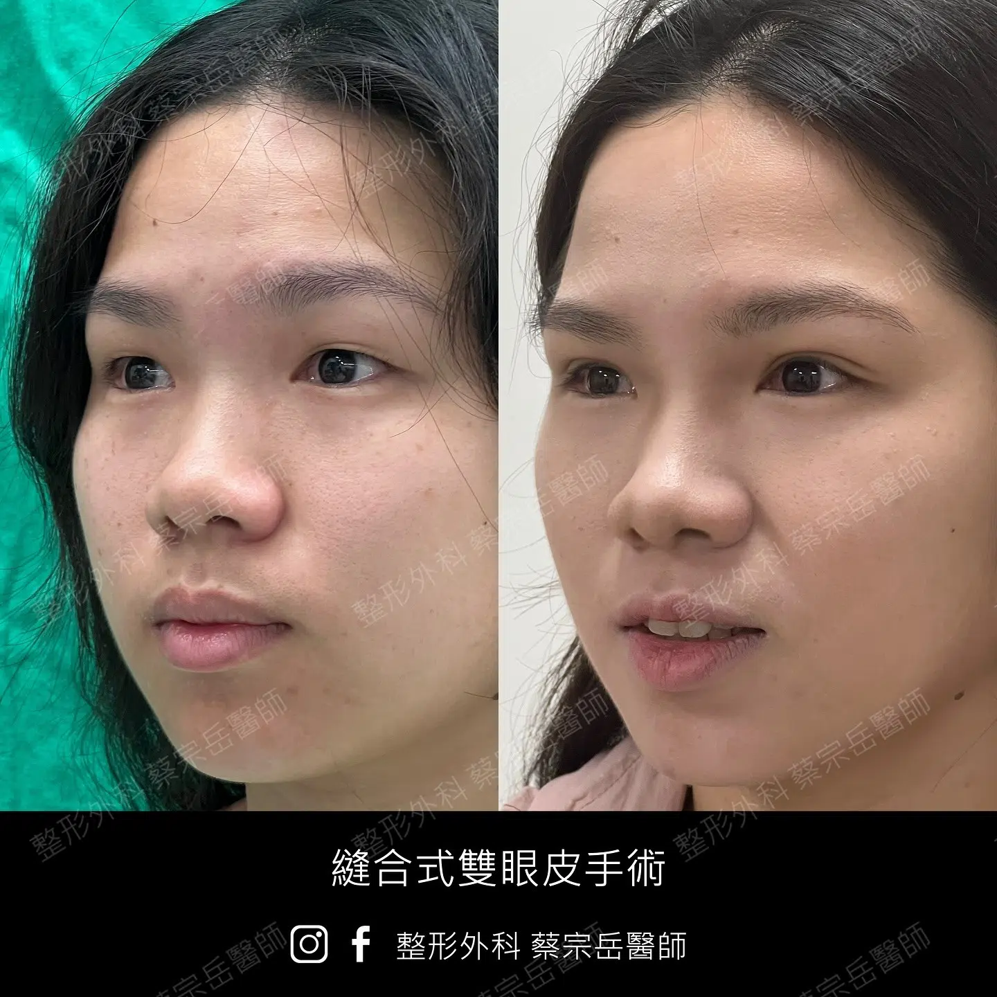 縫合式雙眼皮手術