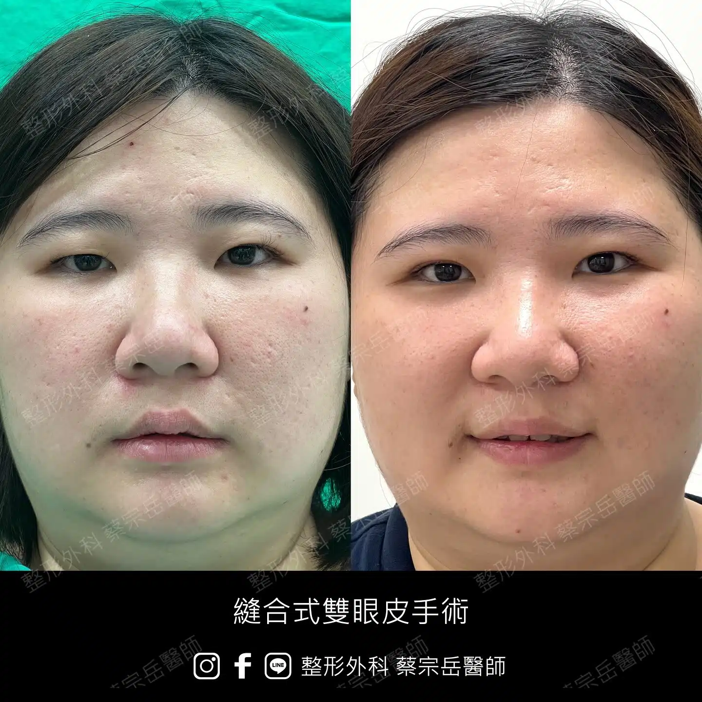 縫合式雙眼皮手術