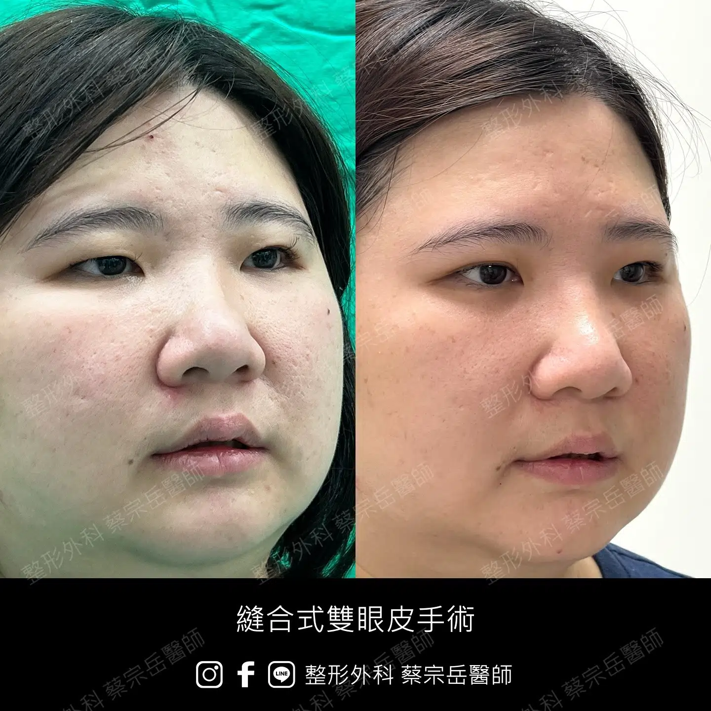 縫合式雙眼皮手術