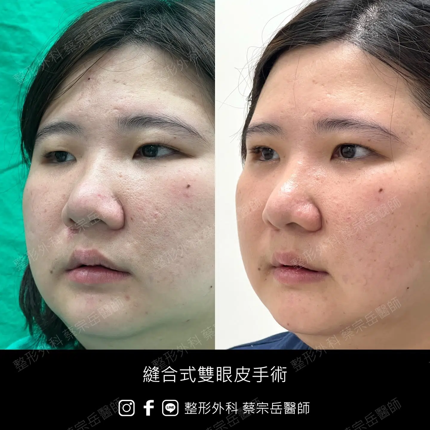 縫合式雙眼皮手術