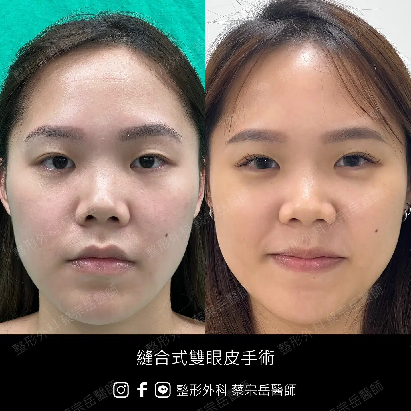 縫合式雙眼皮手術