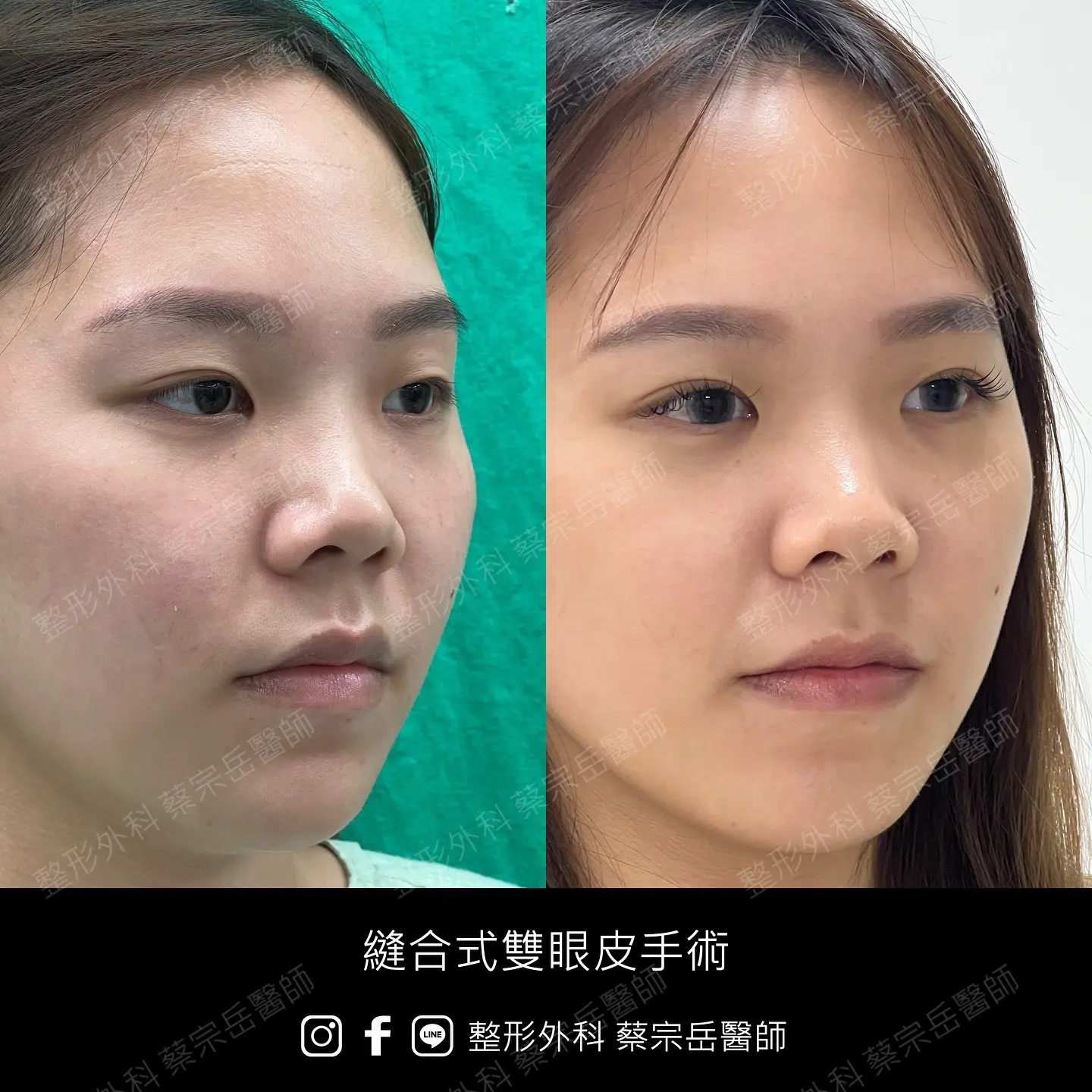 縫合式雙眼皮手術