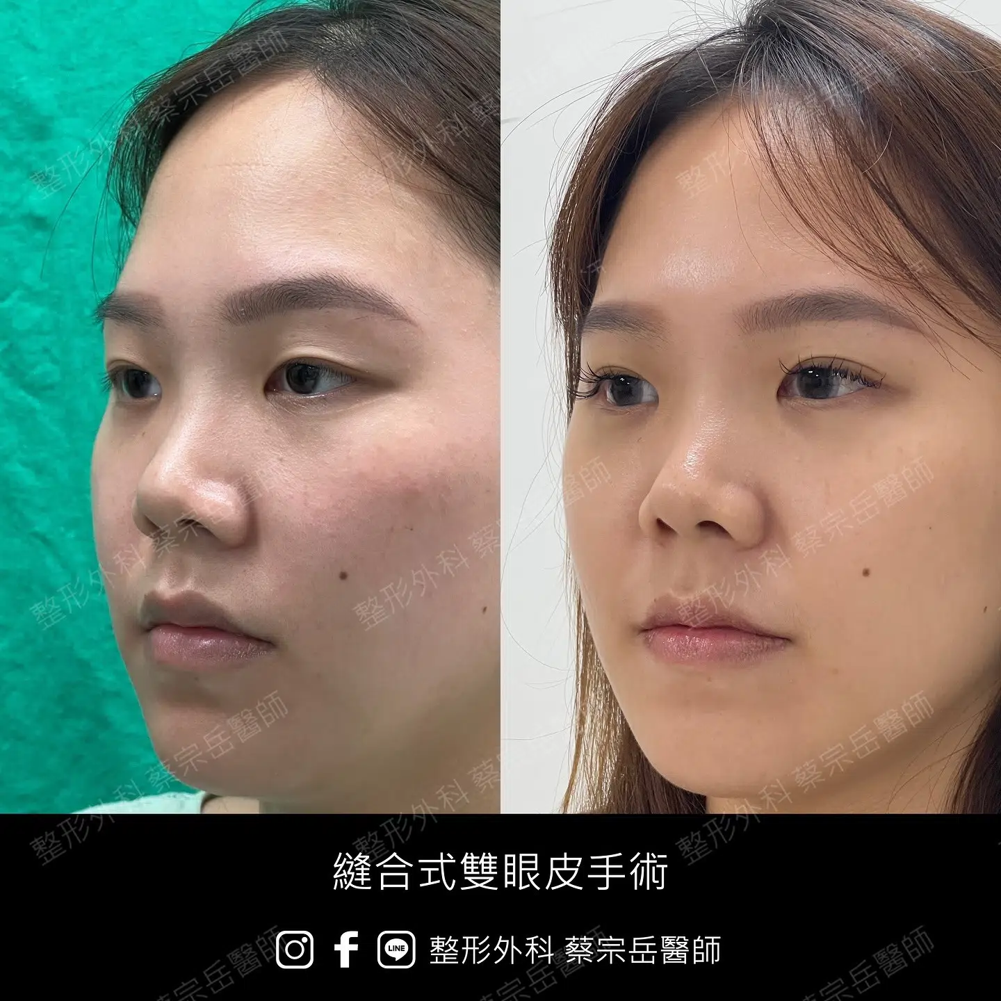 縫合式雙眼皮手術