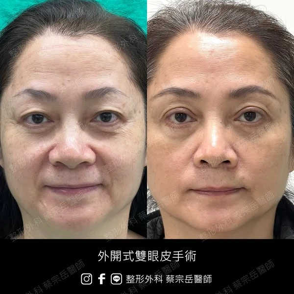 縫合式雙眼皮手術