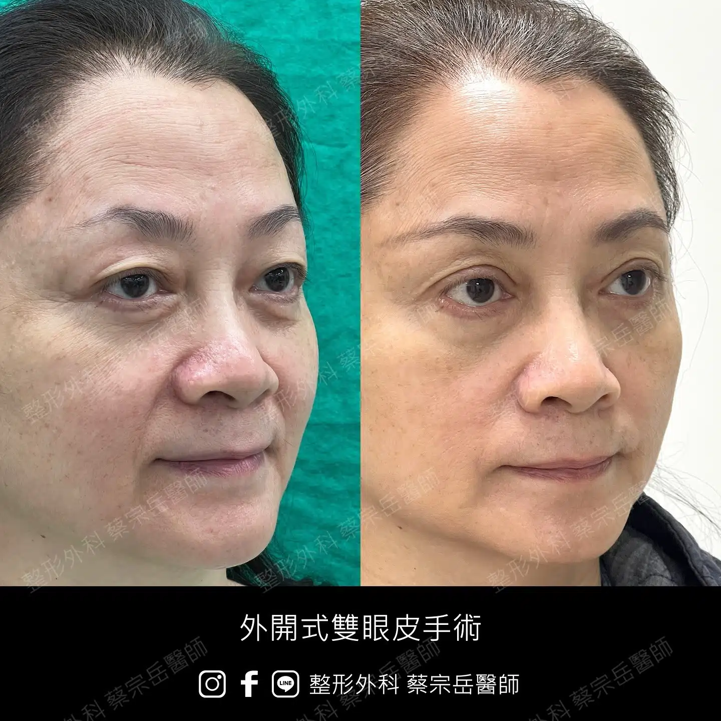 縫合式雙眼皮手術