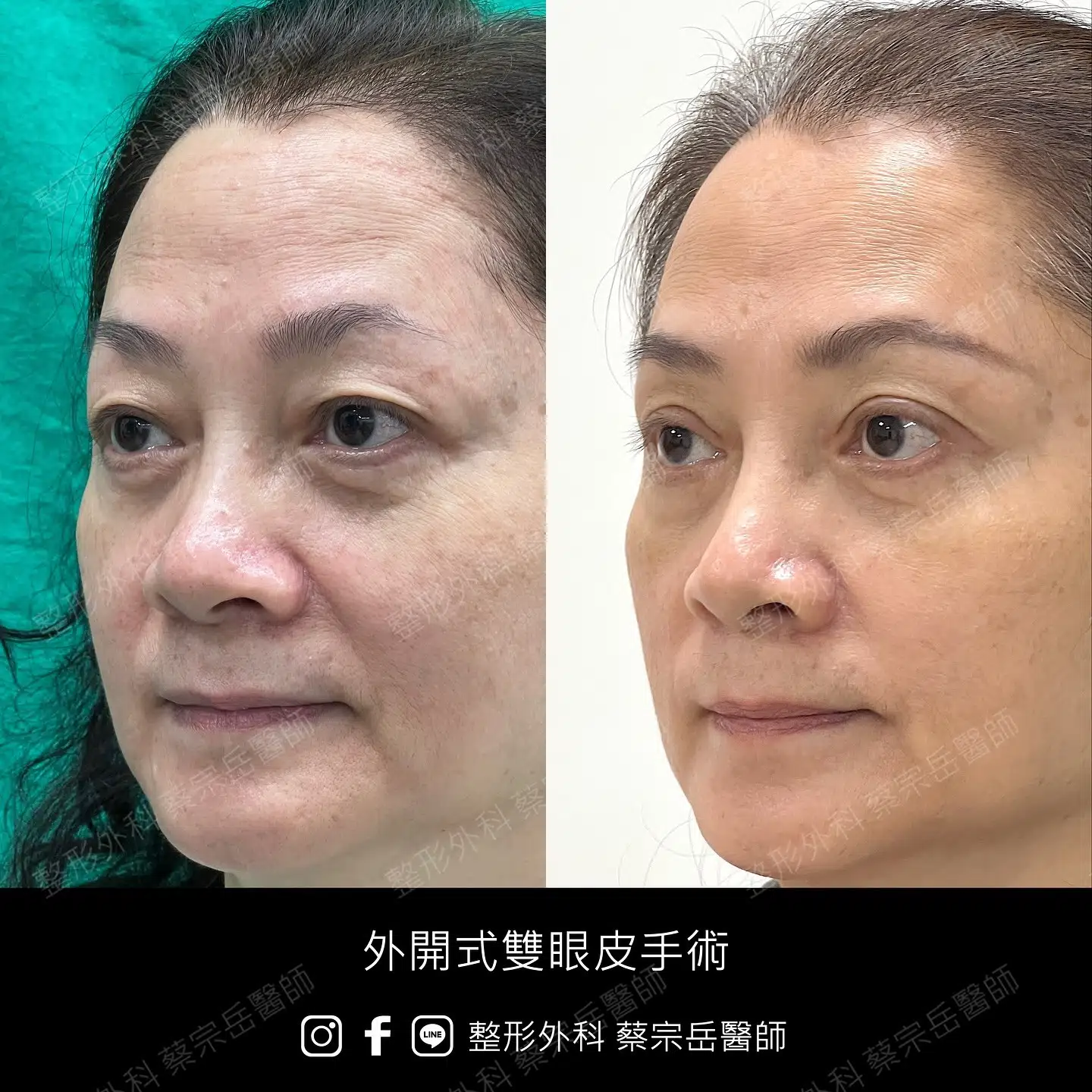 縫合式雙眼皮手術