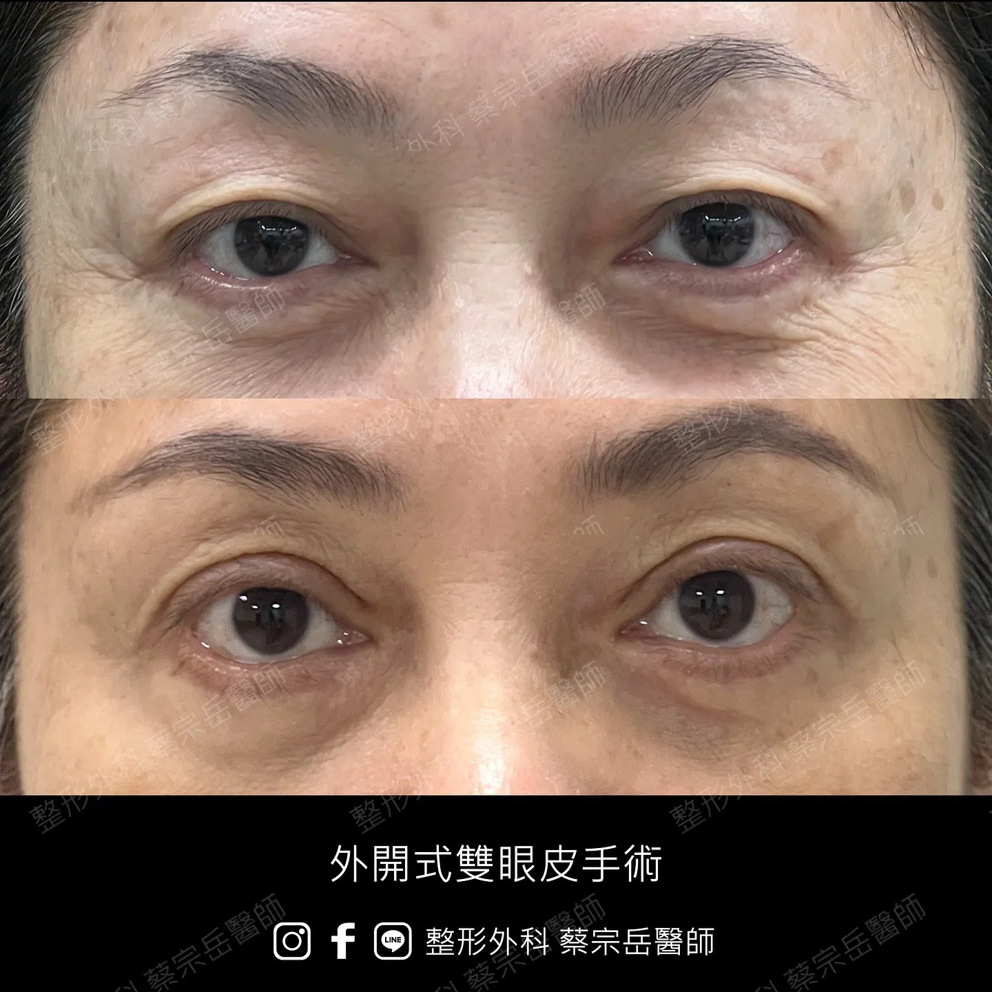 縫合式雙眼皮手術