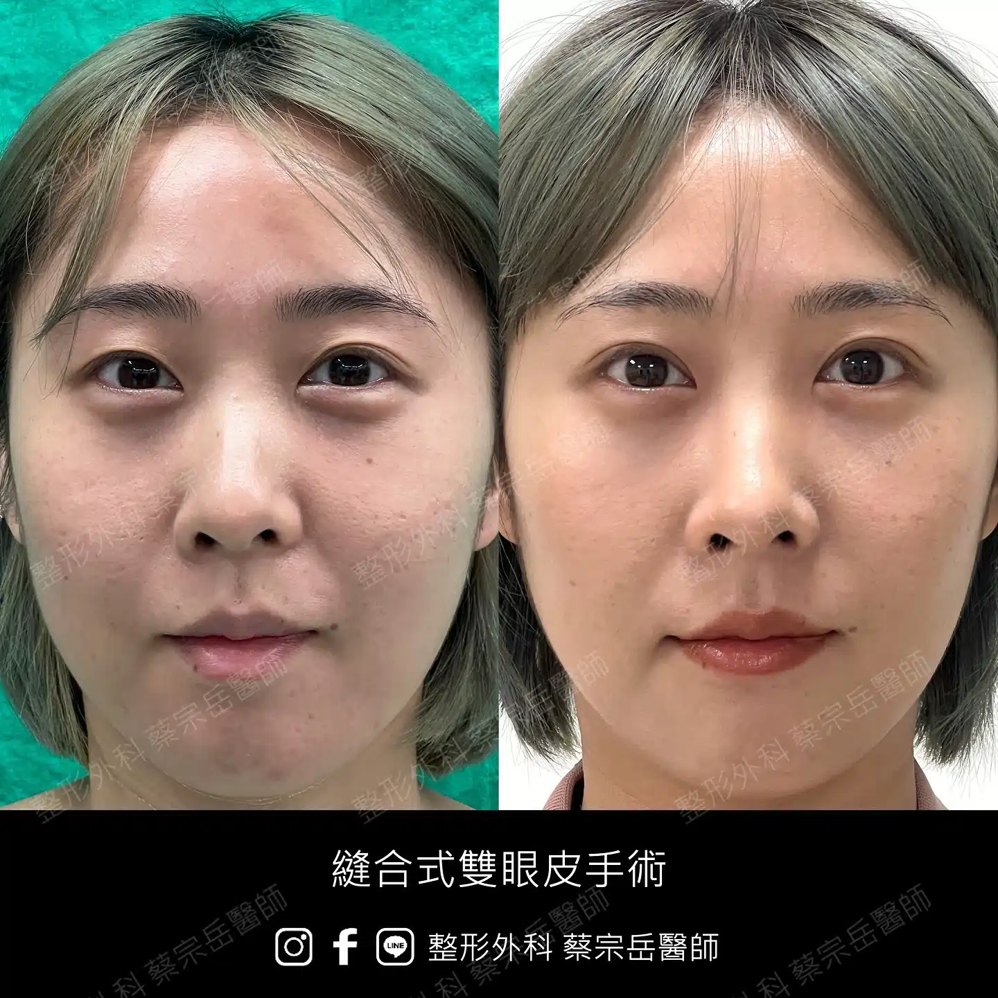 縫合式雙眼皮手術