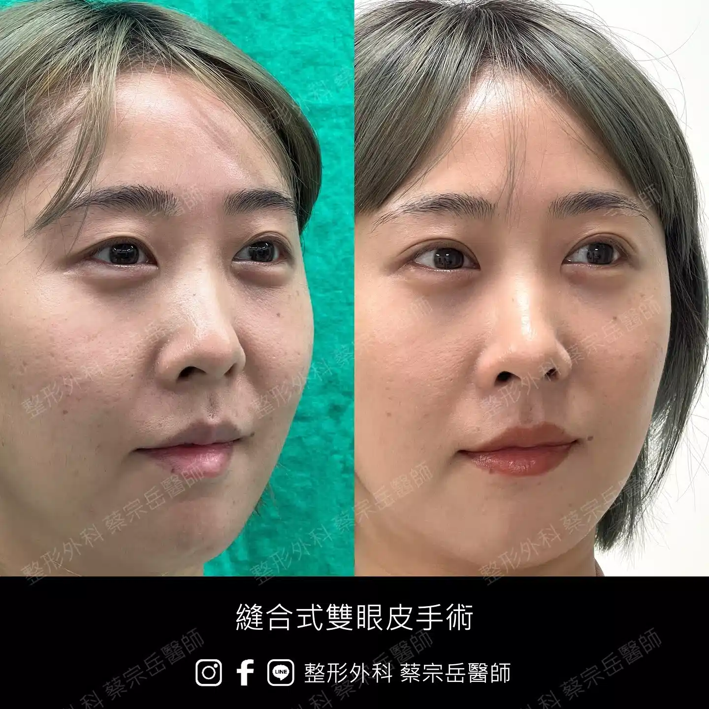 縫合式雙眼皮手術