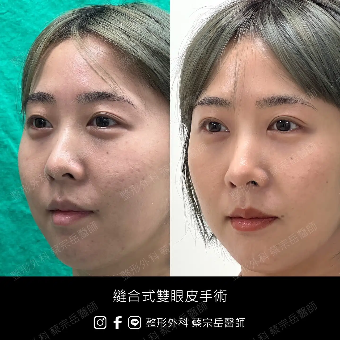 縫合式雙眼皮手術