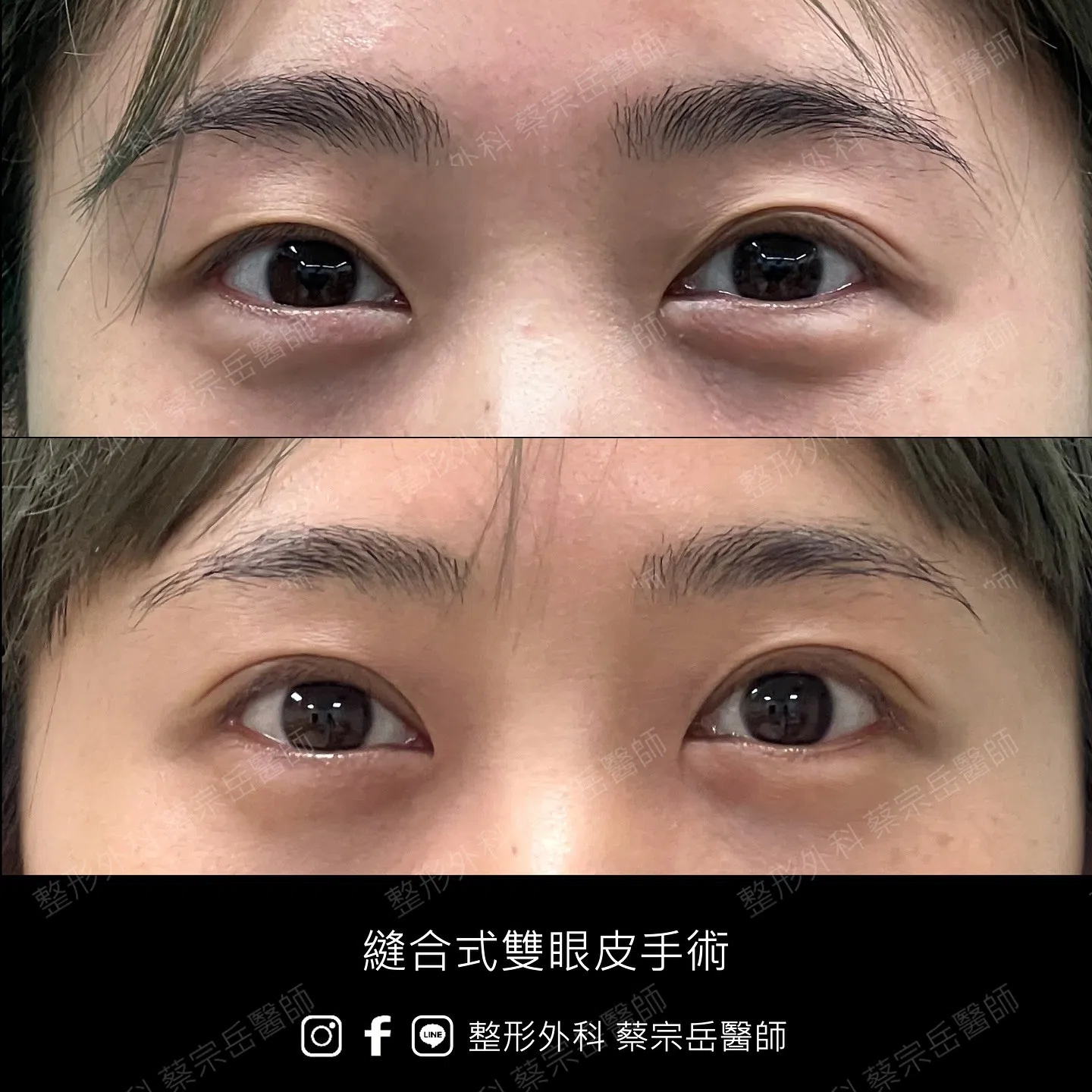 縫合式雙眼皮手術