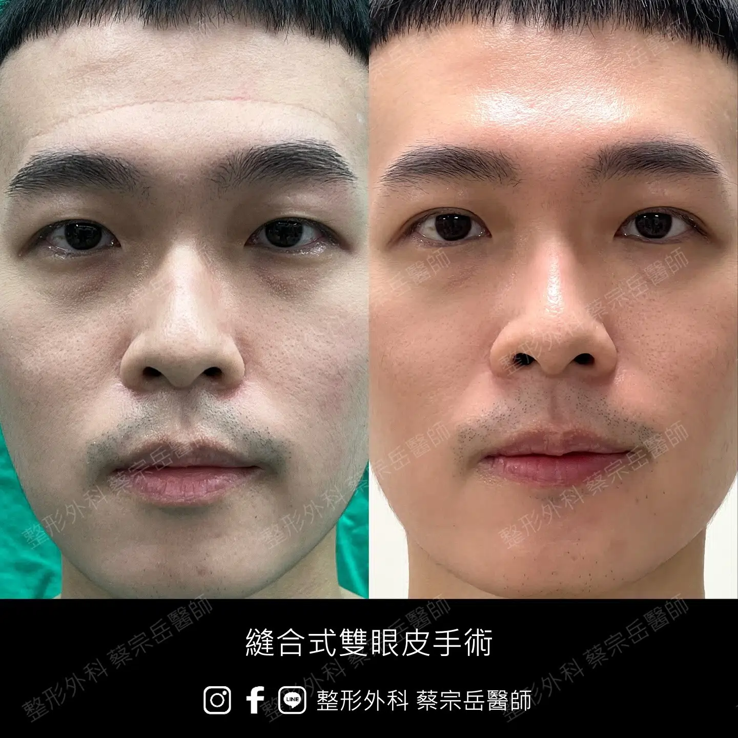 縫合式雙眼皮手術