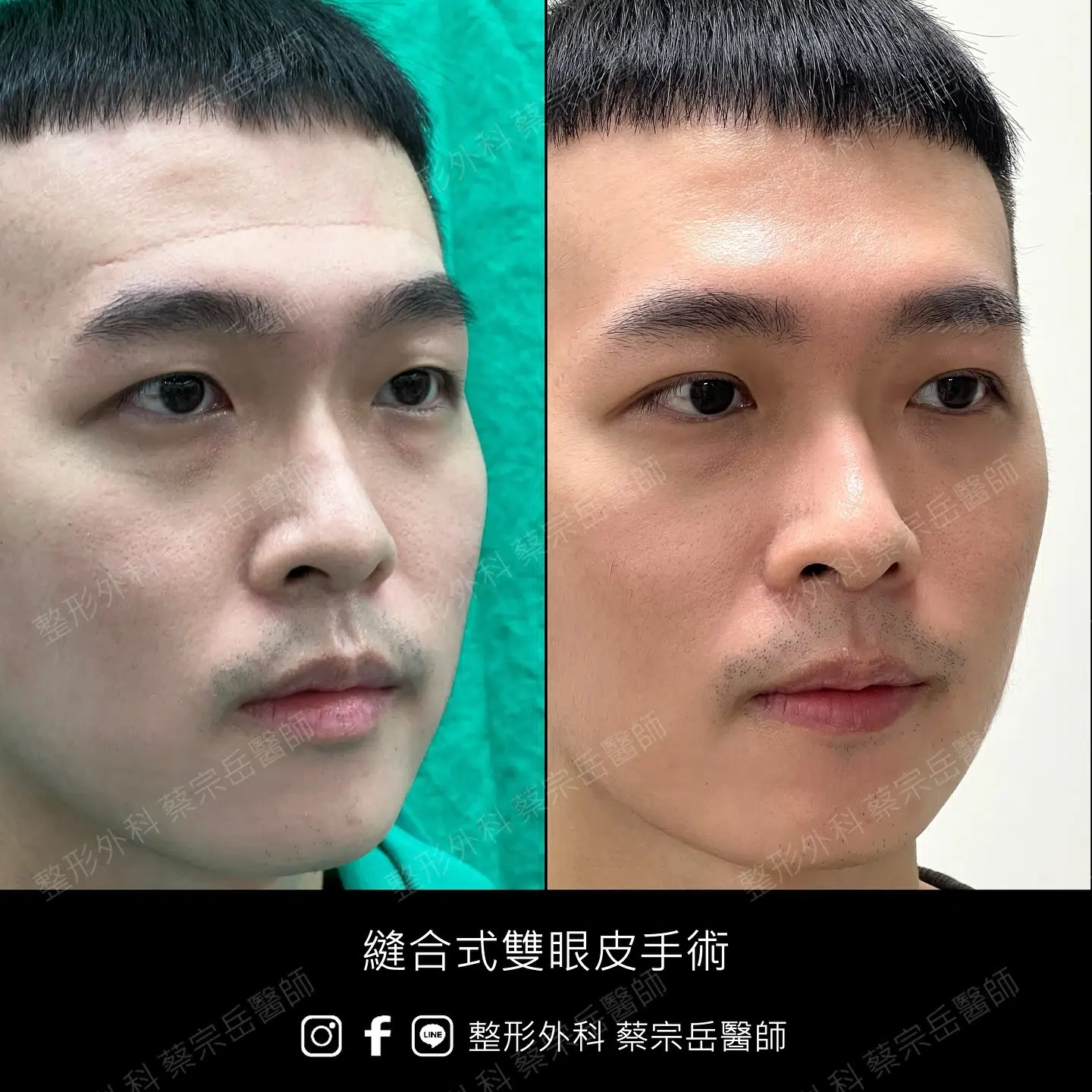 縫合式雙眼皮手術