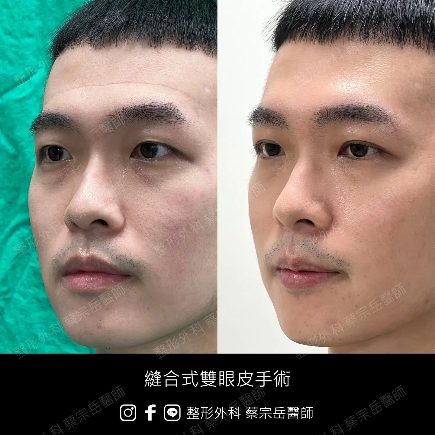 縫合式雙眼皮手術