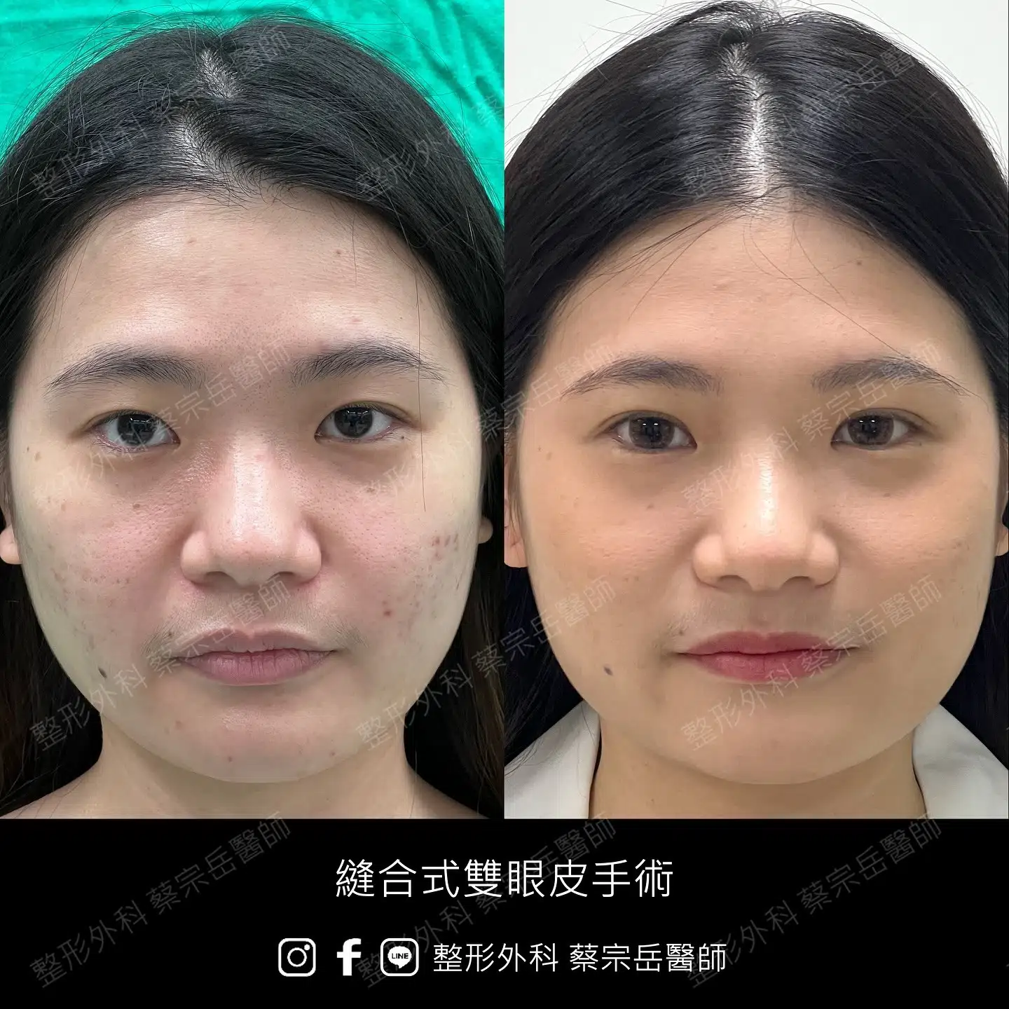 縫合式雙眼皮手術