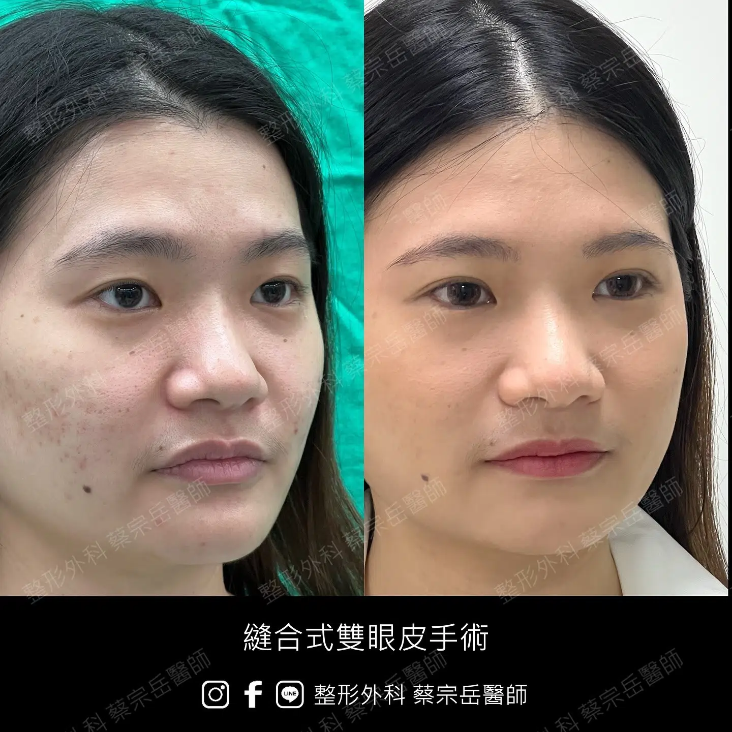 縫合式雙眼皮手術