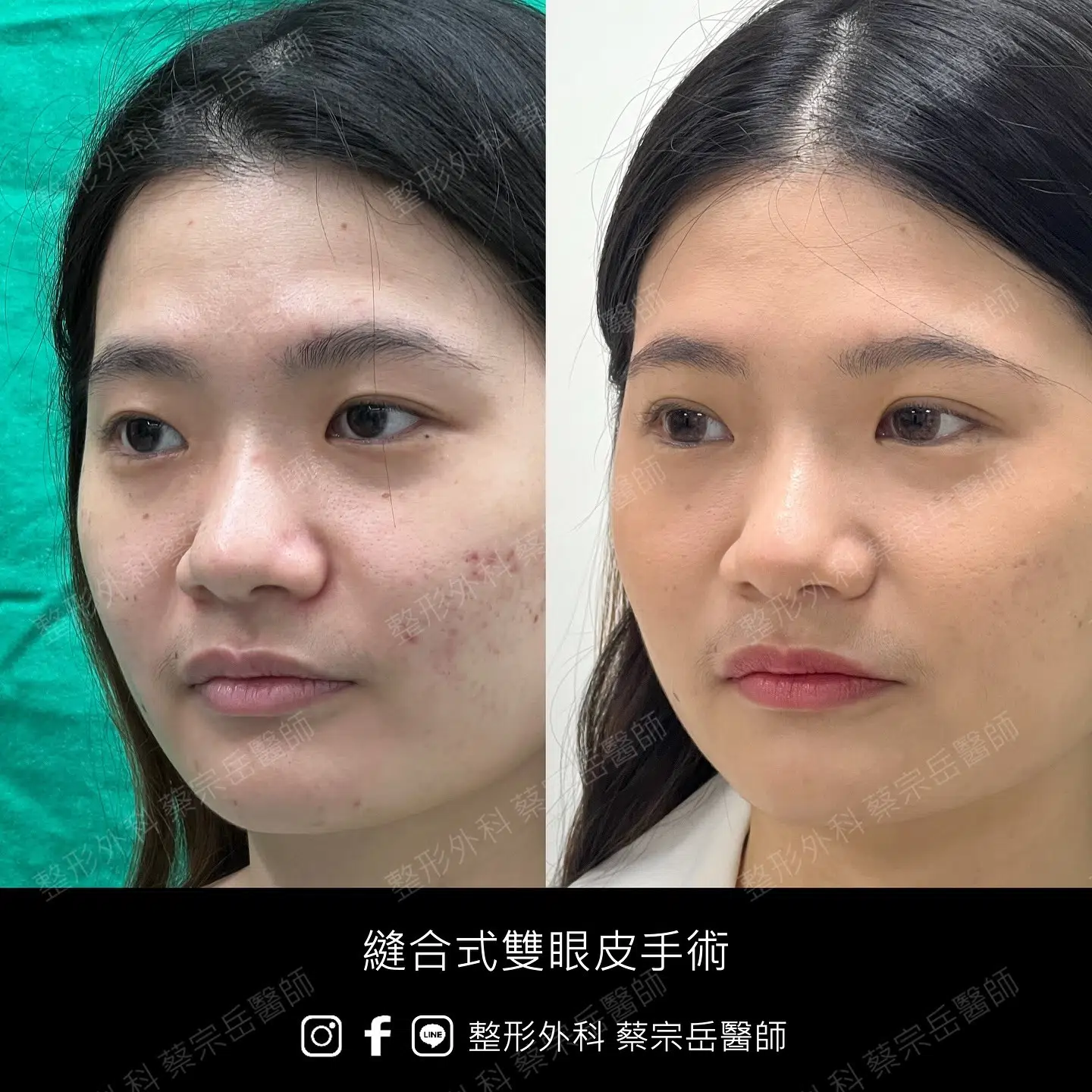 縫合式雙眼皮手術