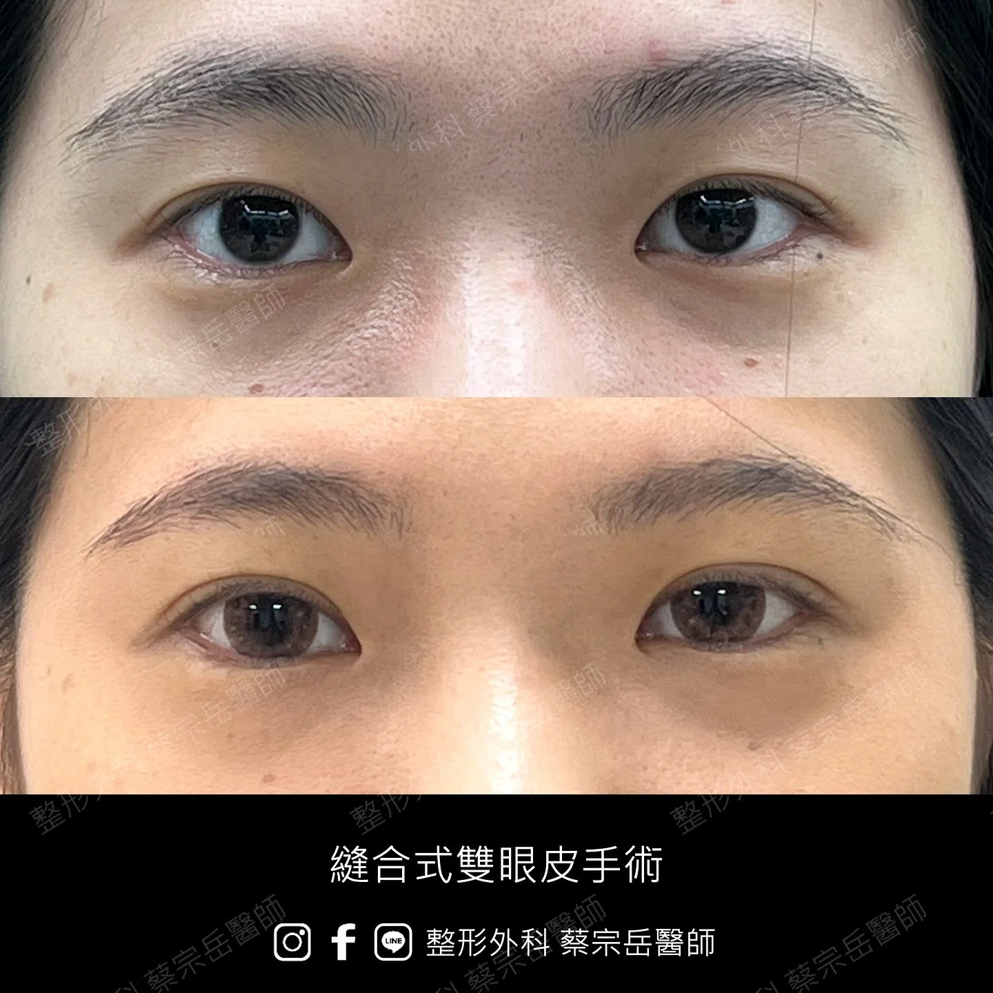縫合式雙眼皮手術