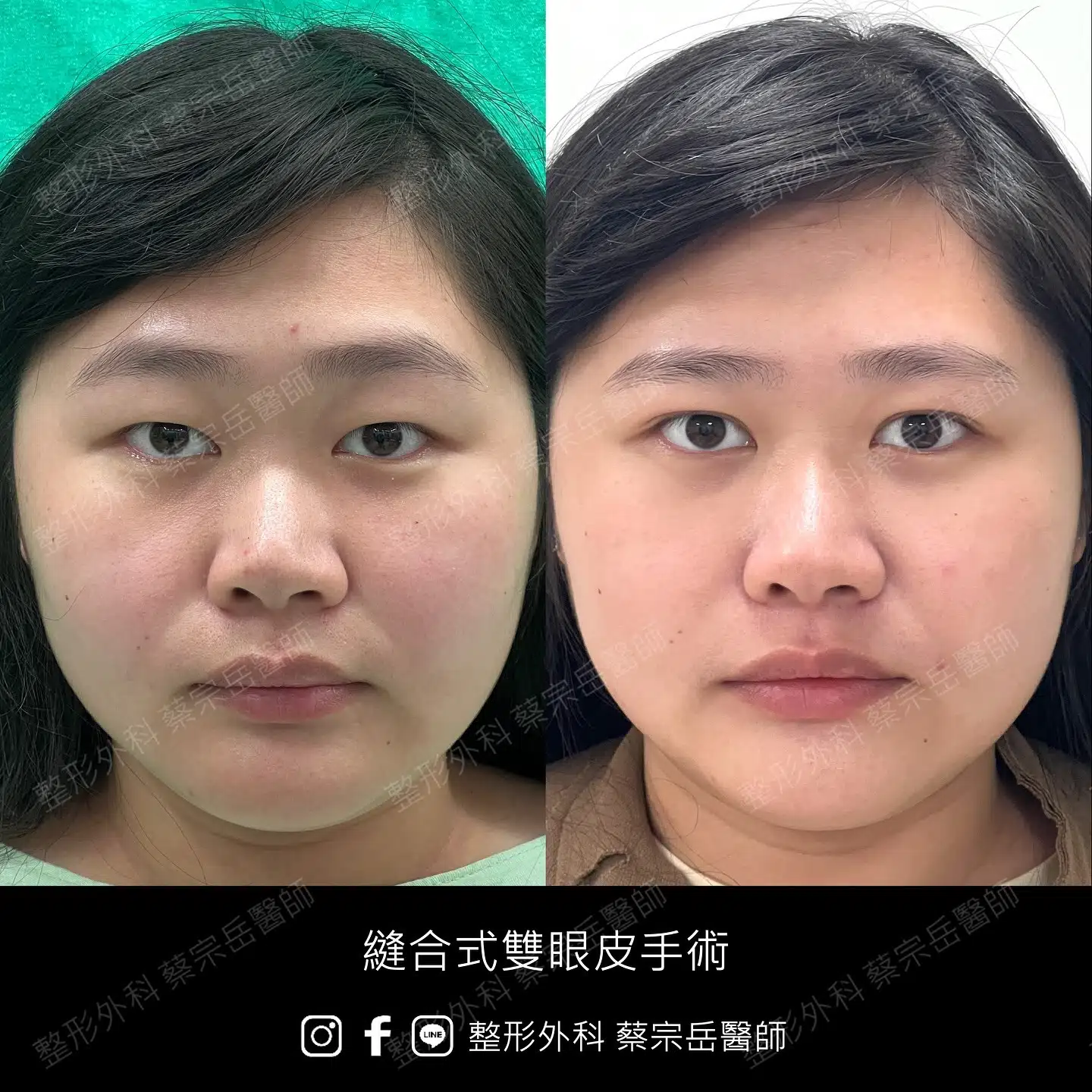 縫合式雙眼皮手術