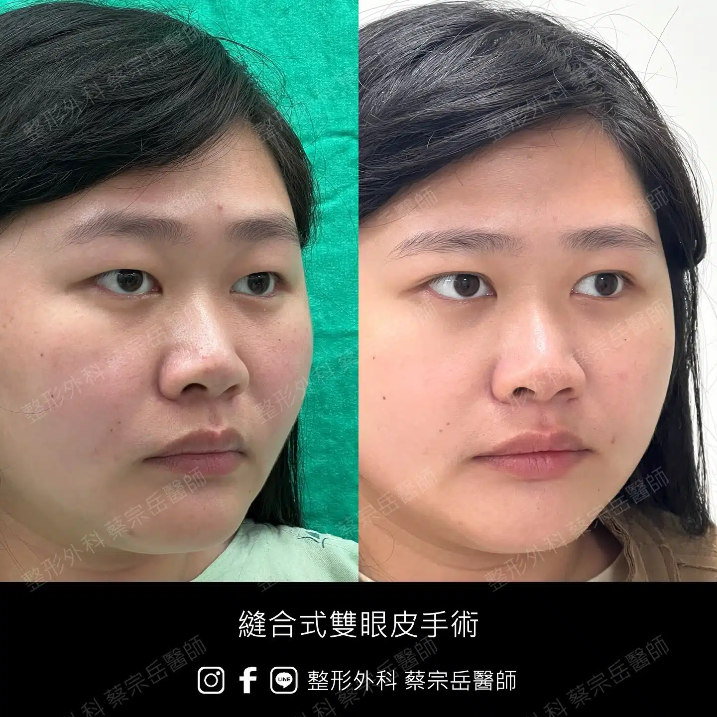 縫合式雙眼皮手術