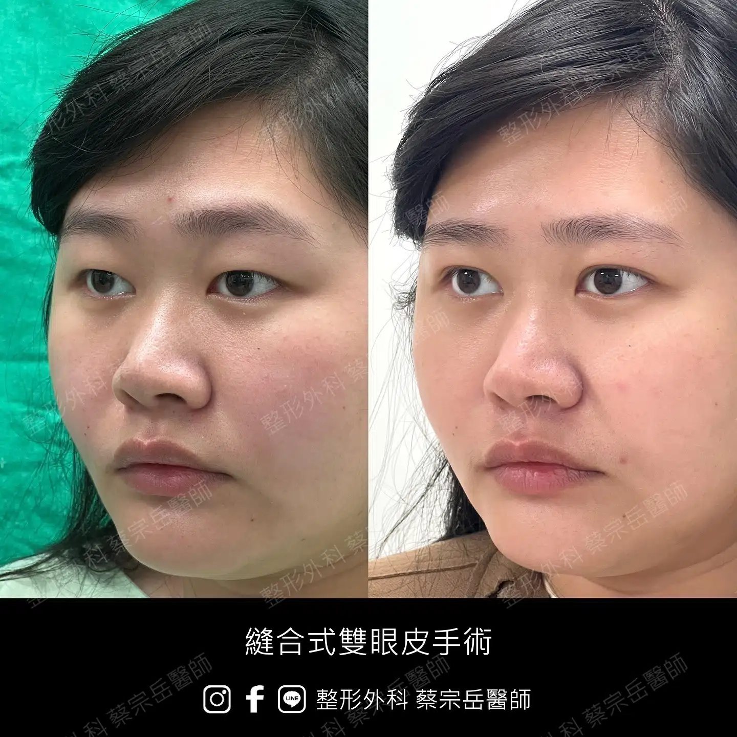 縫合式雙眼皮手術