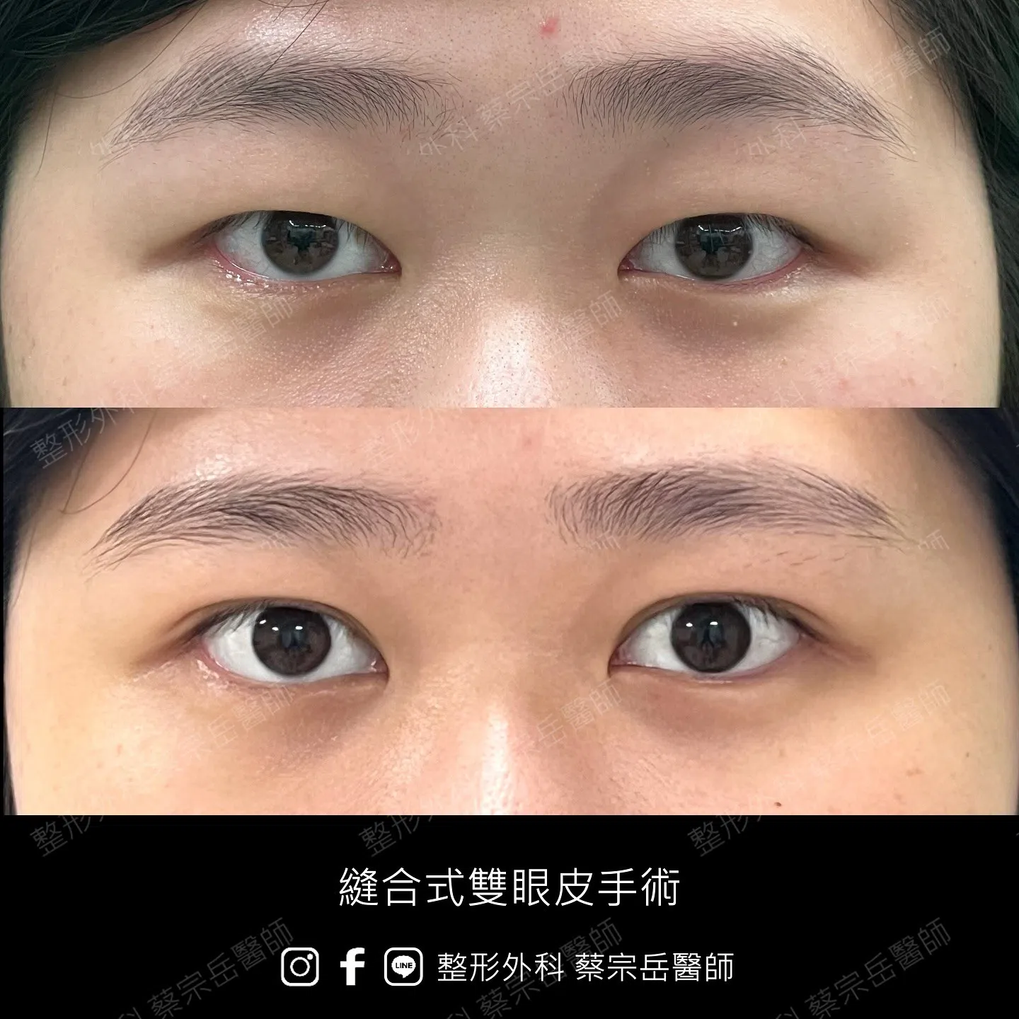 縫合式雙眼皮手術