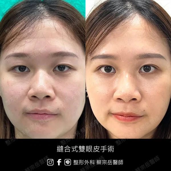 縫合式雙眼皮手術