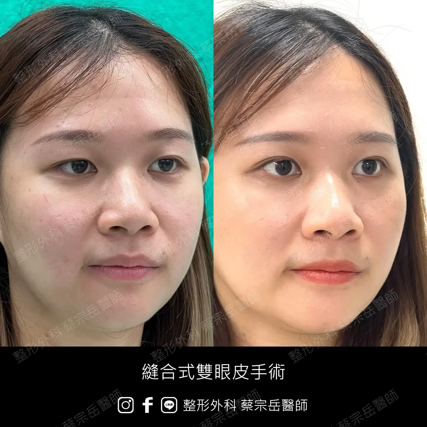 縫合式雙眼皮手術