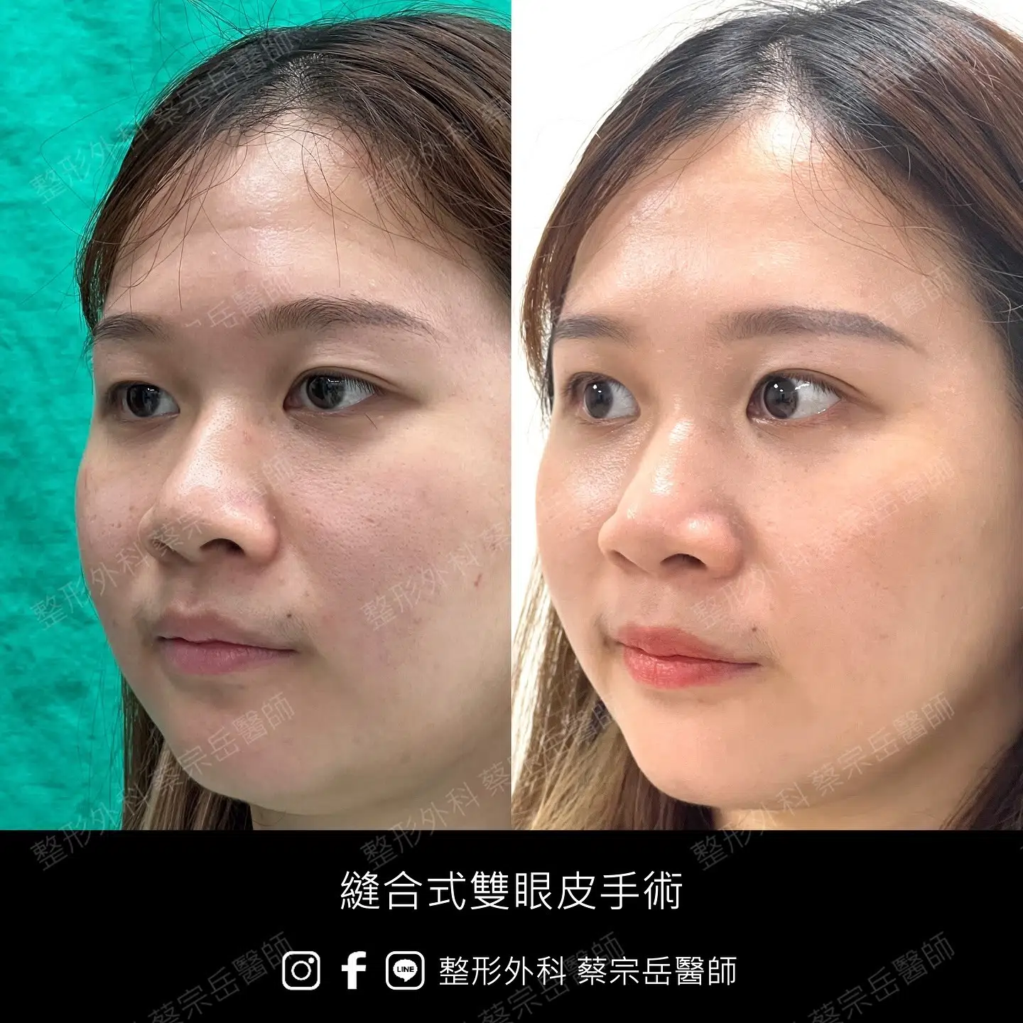 縫合式雙眼皮手術