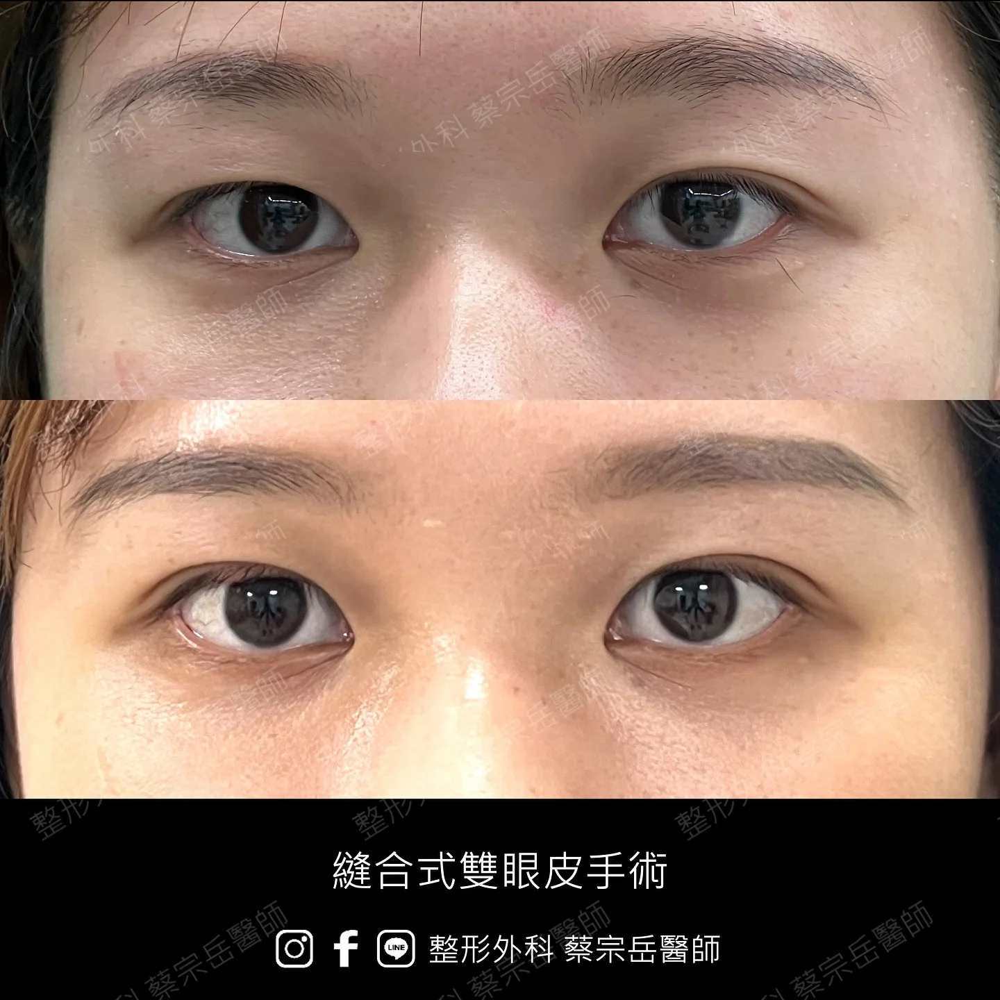 縫合式雙眼皮手術