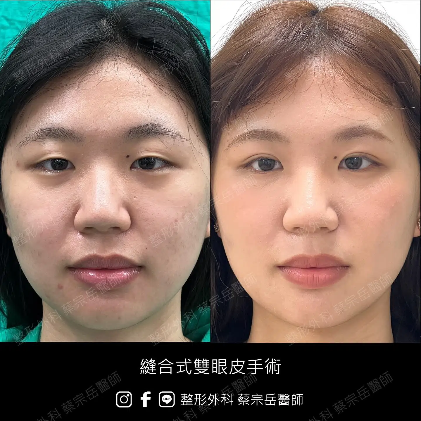 縫合式雙眼皮手術