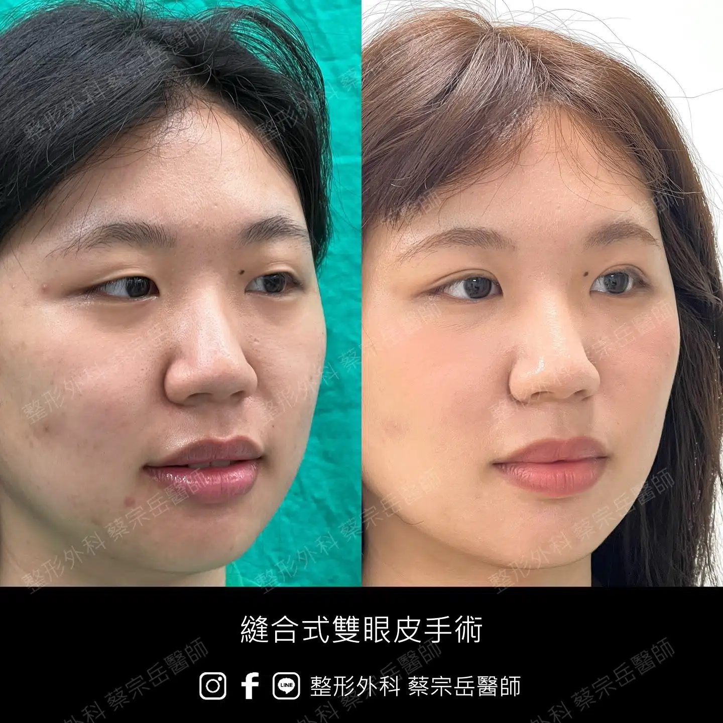 縫合式雙眼皮手術