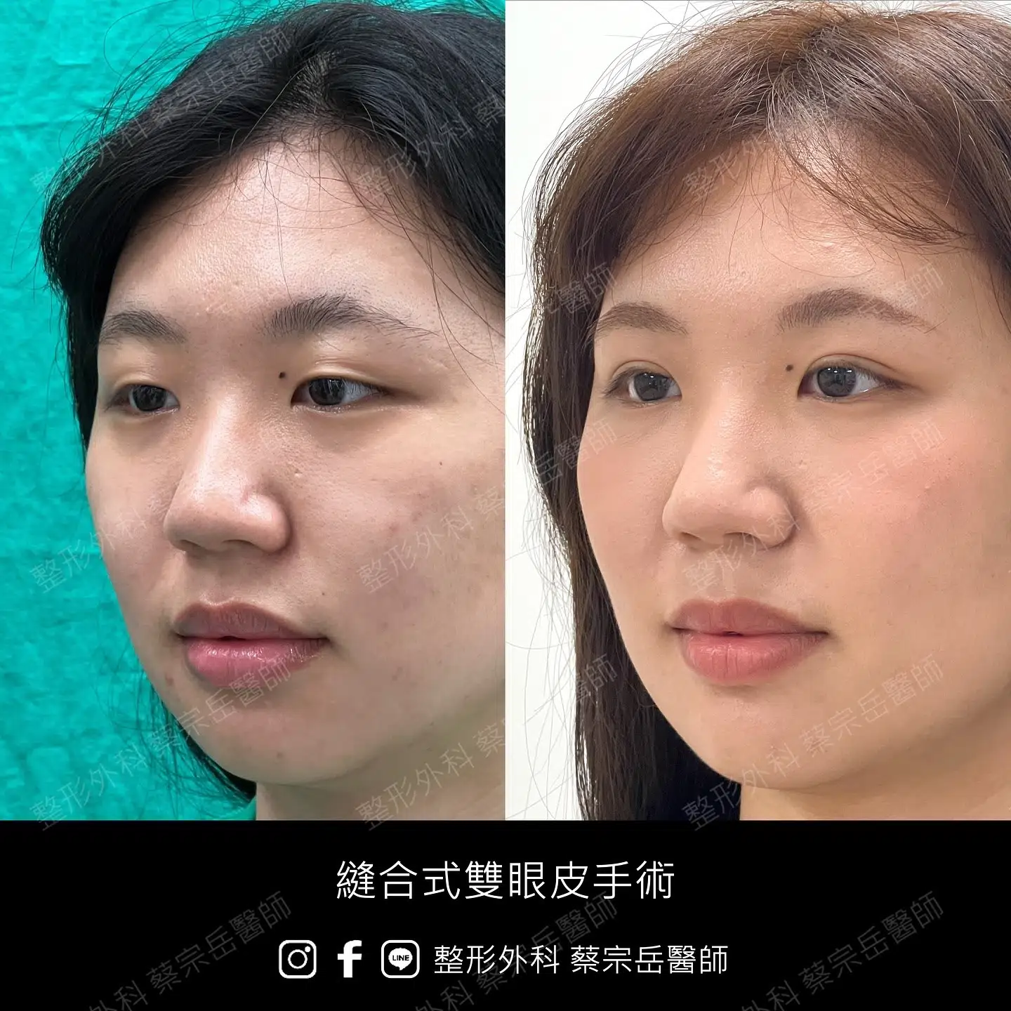 縫合式雙眼皮手術