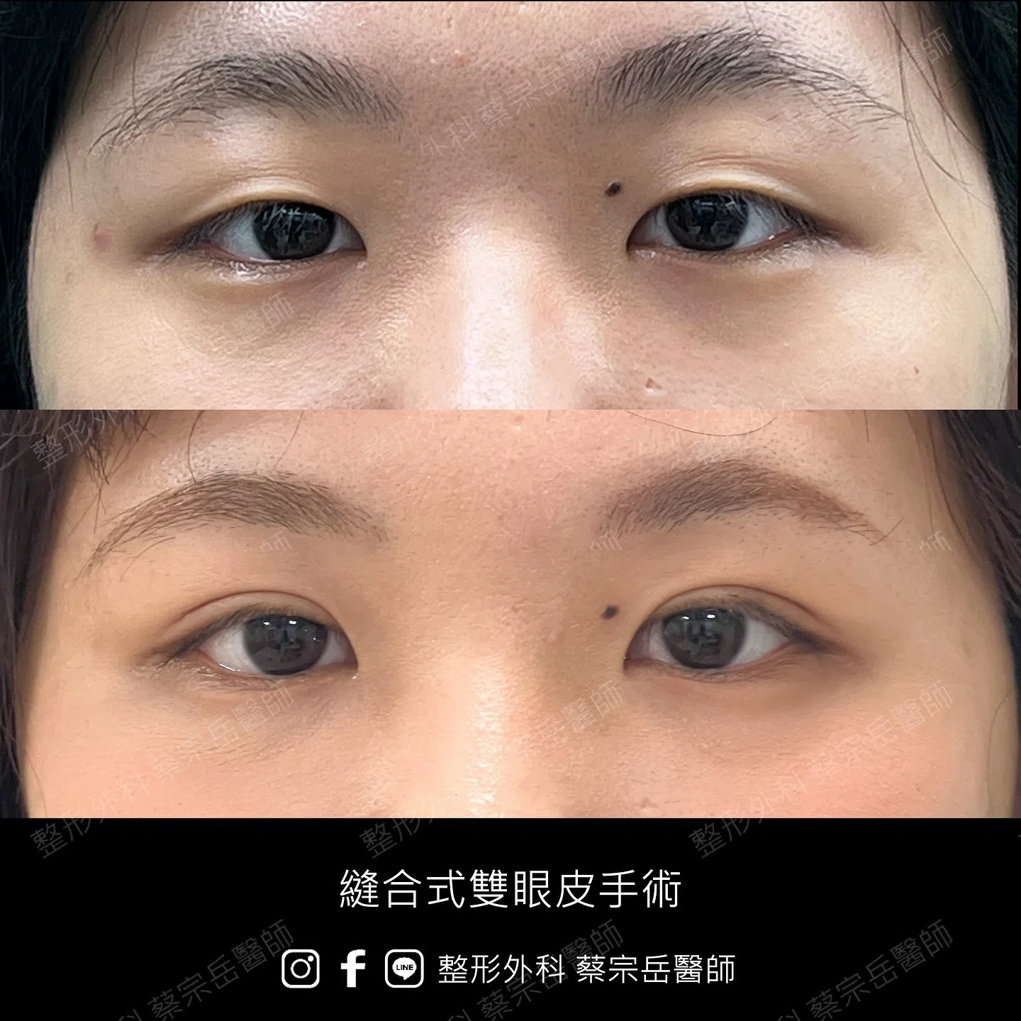 縫合式雙眼皮手術