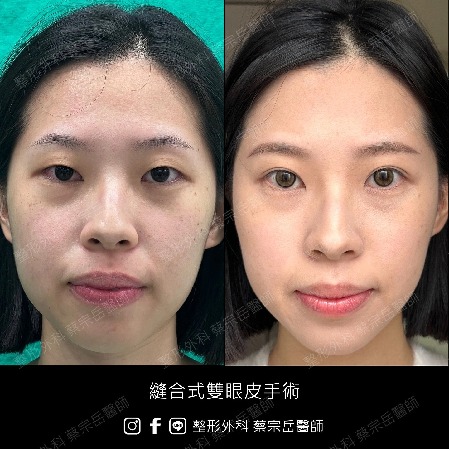 縫合式雙眼皮手術