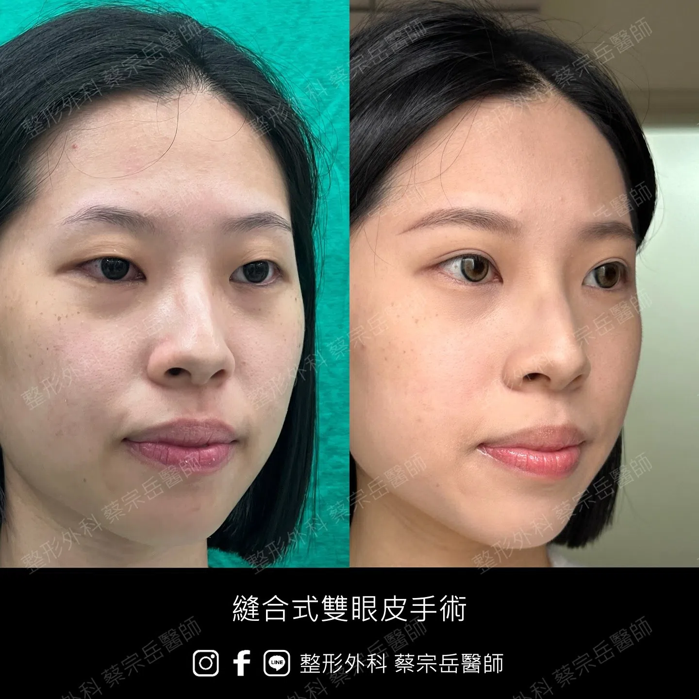 縫合式雙眼皮手術